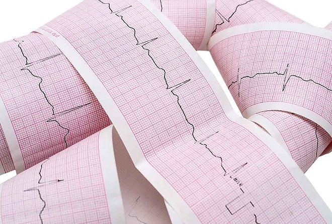 ekg_sziv_szivritmuszavar.jpg ekg_sziv_szivritmuszavar.jpg